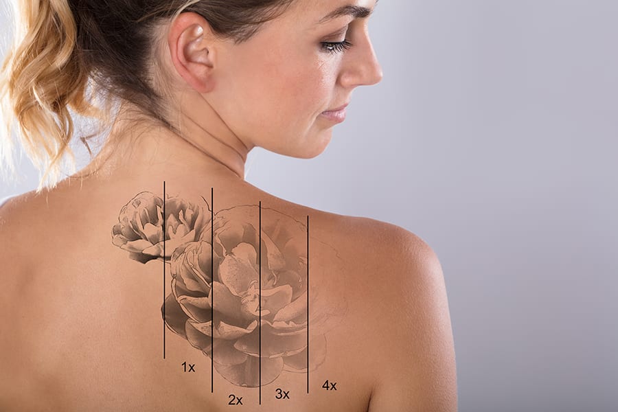 Borrado de Tatuajes con Q-Switched